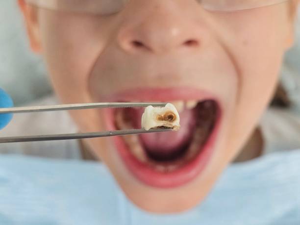 Best Emergency Tooth Extraction in Magee, MS
